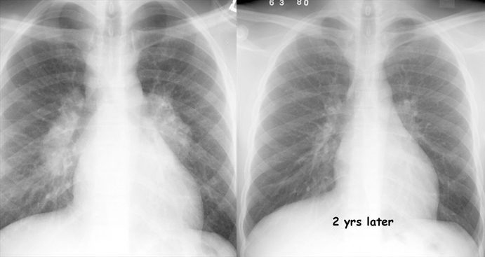 Sarcoid
Case 6 2 yrs apart