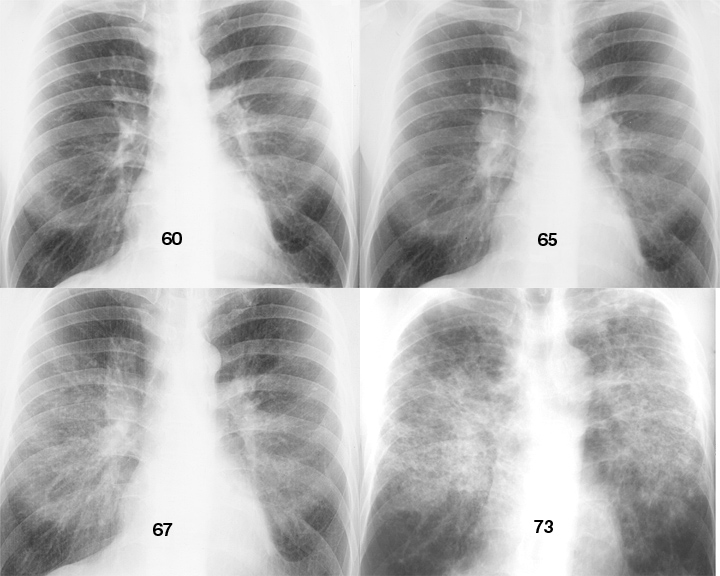 Sarcoid
Case 6 1965-73