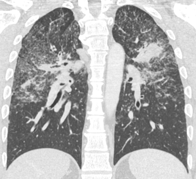 Sarcoid Coronal CT
Case 8