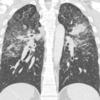 Sarcoid Coronal CT
Case 8