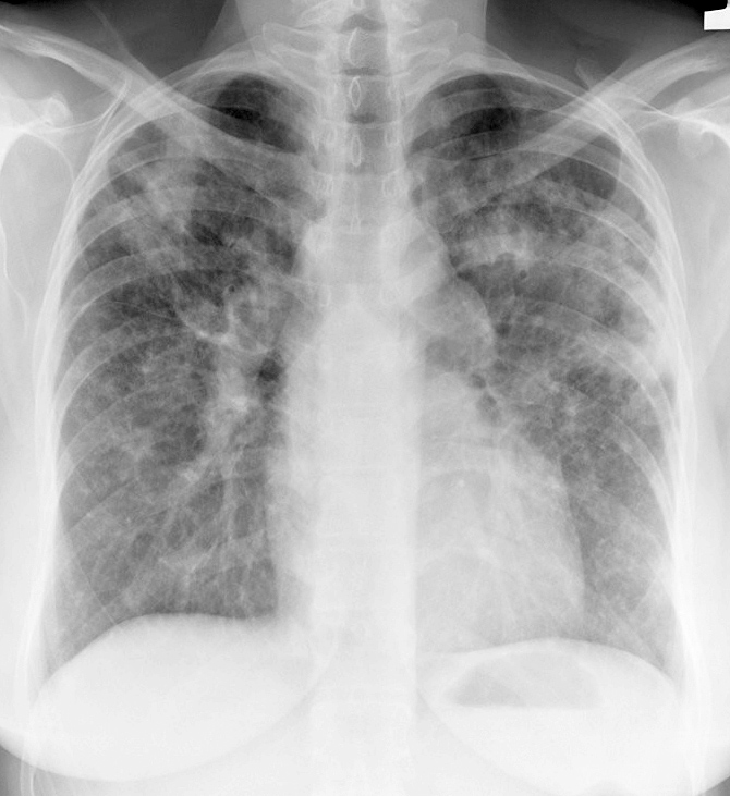 Sarcoid
Case 11 PA(b)