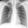 Sarcoid
Case 12 PA