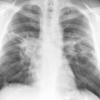 Sarcoid
Case 13 PA