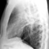 Sarcoid
Case 13 Lat