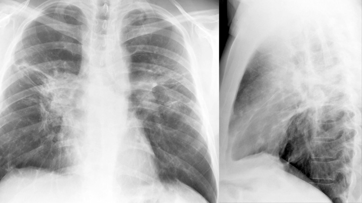 Sarcoid
Case 13 PA & Lat