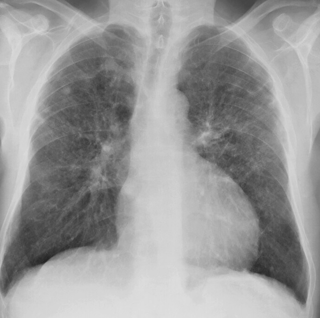 Sarcoid
Case 15 PA