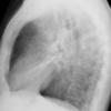 Sarcoid
Case 15 Lat