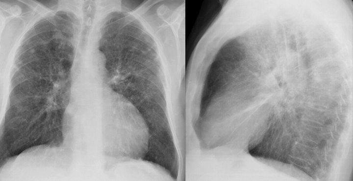 Sarcoid
Case 15 PA & Lat
