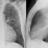 Sarcoid
Case 15 PA & Lat