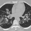 Sarcoid
Case 16 CT4