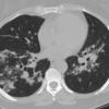 Sarcoid
Case 16 CT5