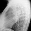 Sarcoid
Case 18 Lat