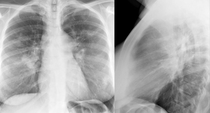 Sarcoid
Case 18 PA & Lat