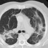 Sarcoid-late
Case 19 CT