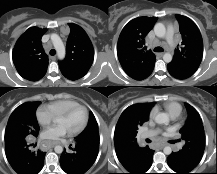 Sarcoid 
Case 20 