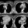 Sarcoid 
Case 20 