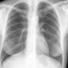 Sarcoid 
Case 21