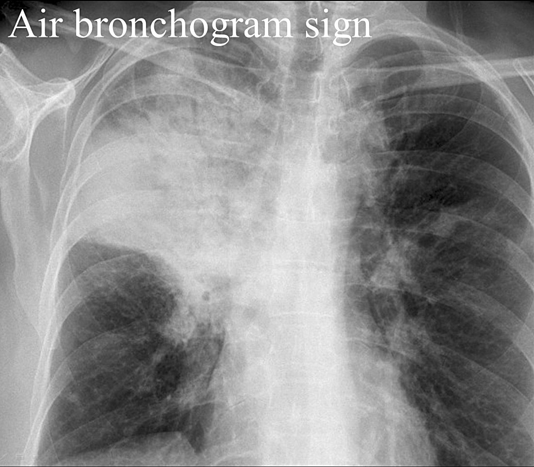 Air bronchogram
