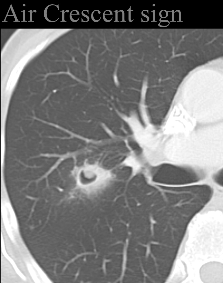 Air crescent sign
invasive aspergillosis