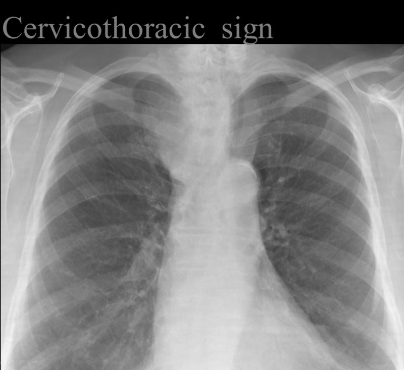 Cervicothoracic sign
(Thyroid mass- see next image)