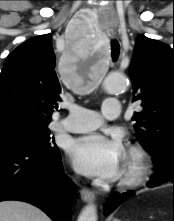 Thyroid mass