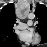 Thyroid mass