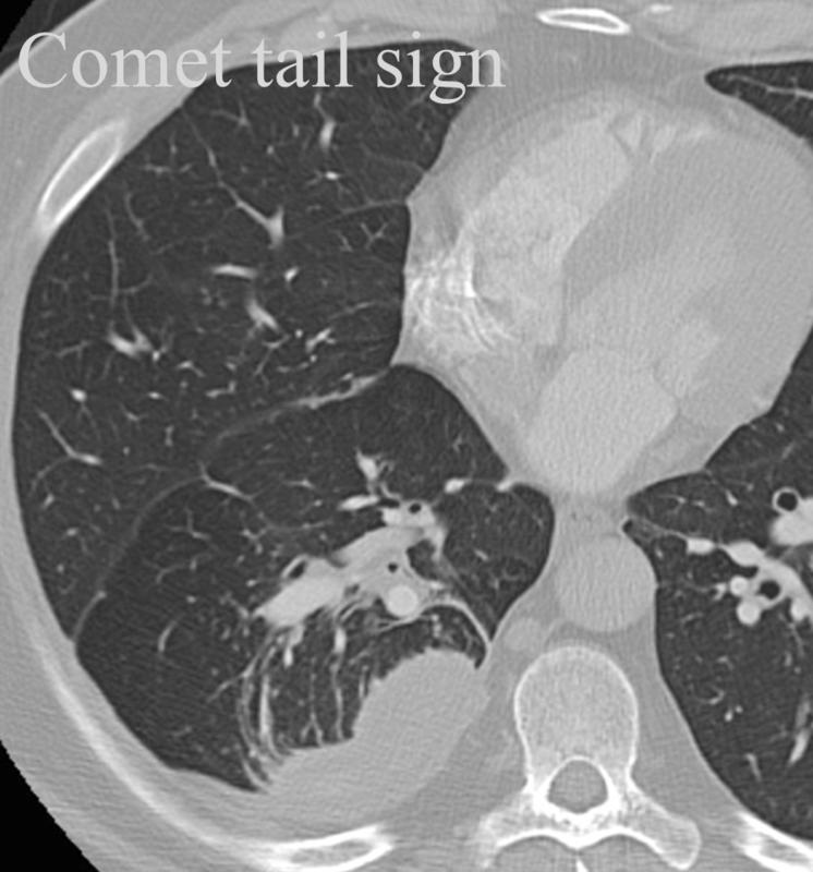 Comet tail sign
Rounded atelectasis
(Initially coined for tomography)