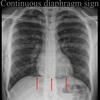 Continuoius diaphragm sign
Pneumomediastinum