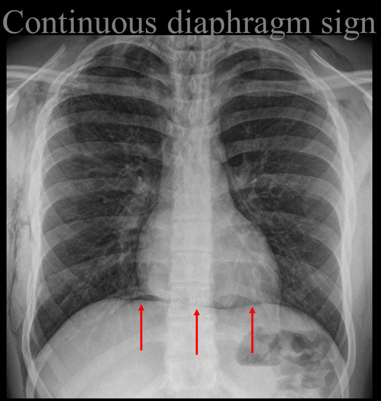 Continuoius diaphragm sign
Pneumomediastinum