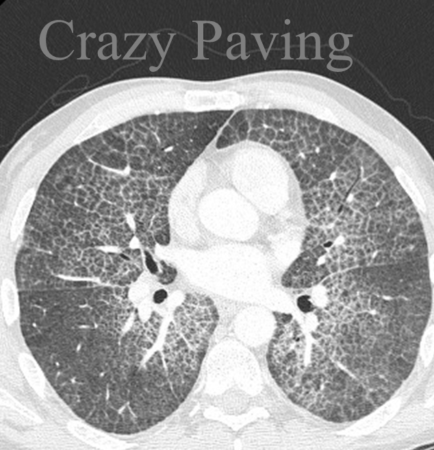 Crazy paving
Alveolar proteinosis - & others