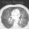 Crazy paving
Alveolar proteinosis - & others