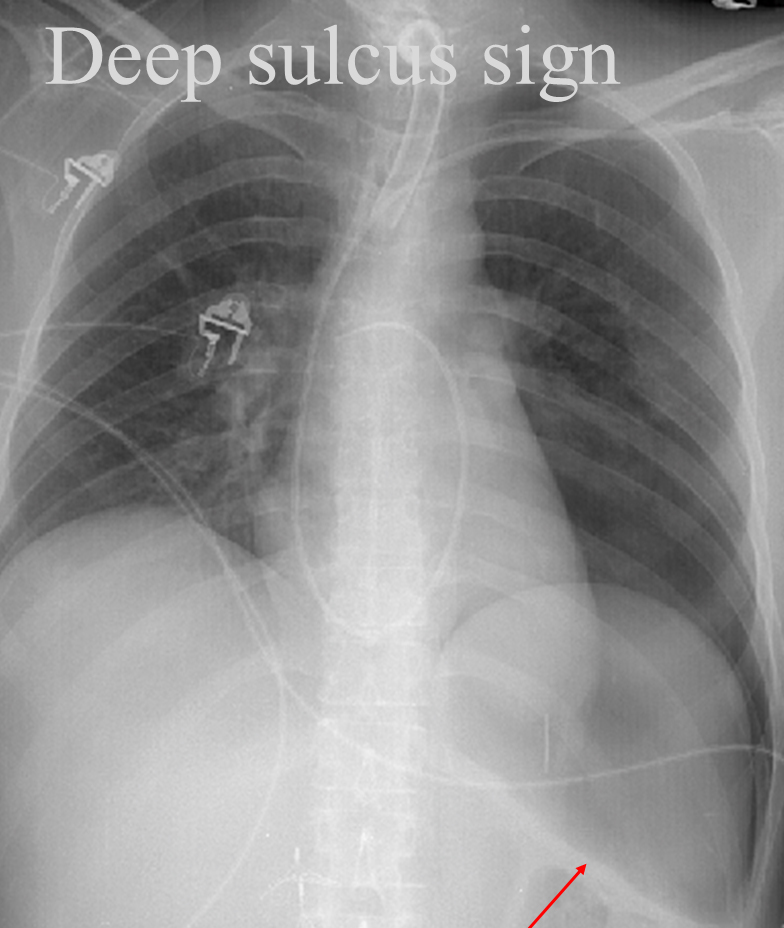 Deep sulcus sign.
Supine pneumothorax