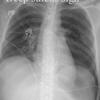 Deep sulcus sign.
Supine pneumothorax