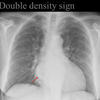 Double density sign
Left atrial enlargement