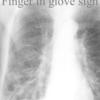 Finger in glove sign
RLL bronchiectasis