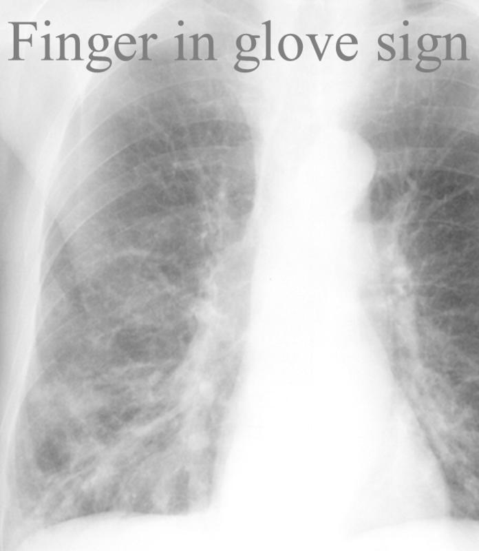 Finger in glove sign
RLL bronchiectasis