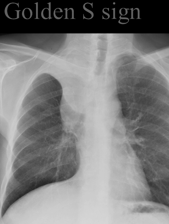 Golden S sign
RUL collapse and central mass