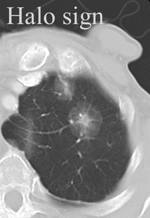 Halo sign