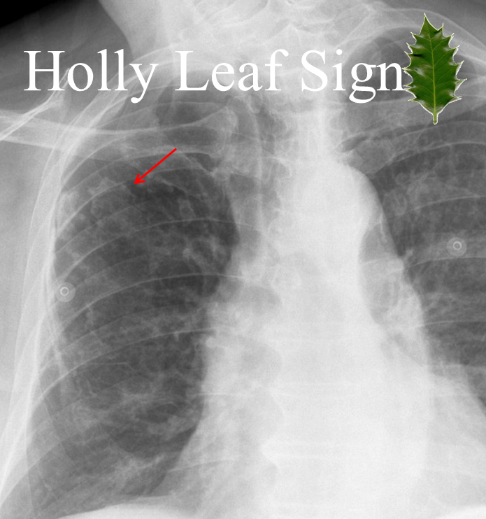 Holly leaf sign
calcified asbestos-related pleural plaque