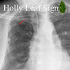 Holly leaf sign
calcified asbestos-related pleural plaque
