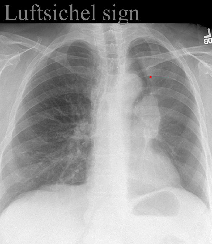 Luftsichel sign
LUL collapse; hyperinflated LLL