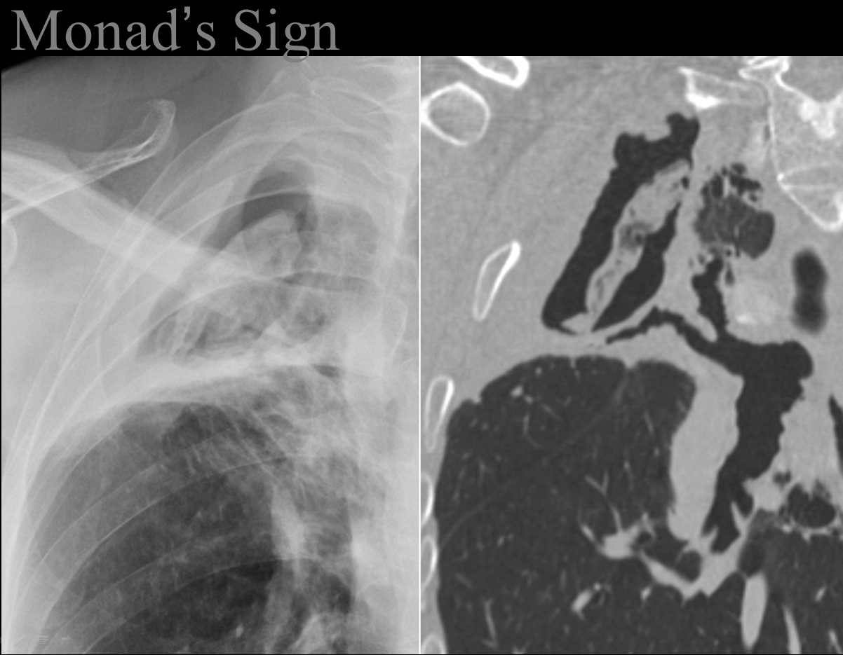 Monad's sign

Aspergilloma