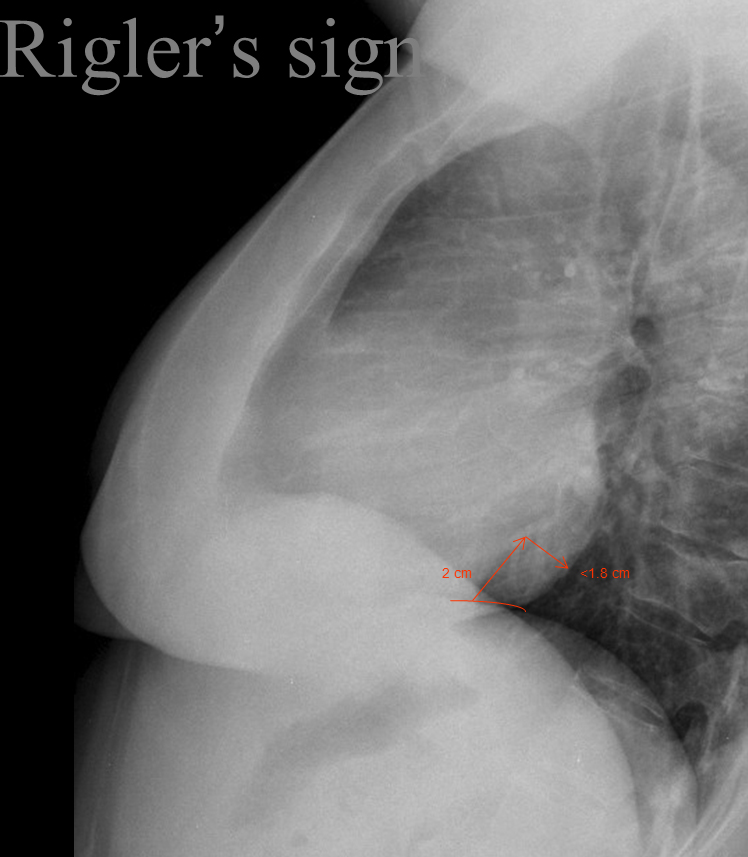 Rigler's sign
to assess LV size