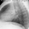 Rugger Jersey sign
2ry hyperparathyroidism in CRF