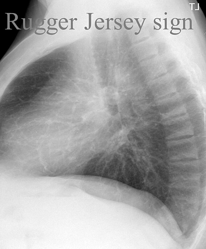 Rugger Jersey sign
2ry hyperparathyroidism in CRF