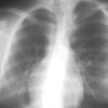 Scimitar sign
Anomalous venus return below the diaphragm
(hypoplastic Rt lung/venolobar syndrome)