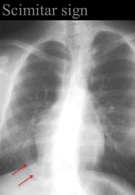 Scimitar sign
Anomalous venus return below the diaphragm
(hypoplastic Rt lung/venolobar syndrome)