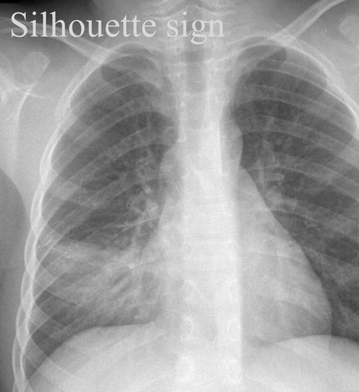 Silhouette sign

RML collapse