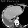 Split pleura sign
Empyema