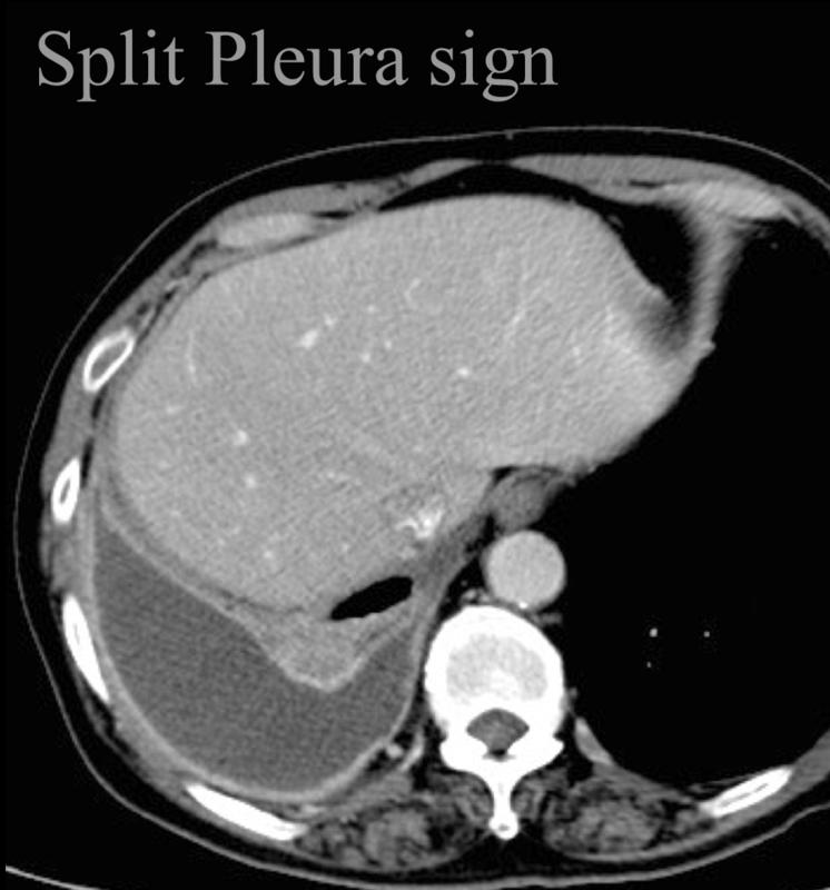 Split pleura sign
Empyema